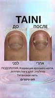 Татьяна (TAINI) — Подолог (Петах-Тиква). Лечение вросшего ногтя и медицинский педикюр, установка титановой нити. טטיאנה (TAINI) - פודיאטרית (פתח תקווה). טיפול בציפורן חודרנית, פדיקור רפואי